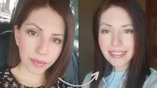 REMOVER LUNARES CON L&Aacute;SER CO2 | MI EXPERIENCIA | Melissa Sacz