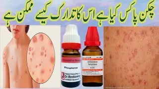 What is Chickenpox?  What are Causes, Signs, Diagnosis and Treatment of Chicken pox in Homoeopathic