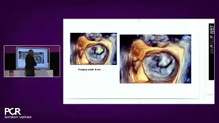 Advancing valve repair: mastering diverse mitral and TR anatomies with the PASCAL Precision system