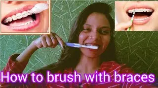 braces journey | how to clean teeth with braces | how to brush with braces | braces clean kaise kare