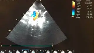 Complete Transposition of the Great Arteries (D-TGA) + PDA