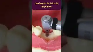 IMPLANTE DENT&Aacute;RIO PASSO A PASSO - COMO &Eacute; FEITO UM IMPLANTE DENT&Aacute;RIO