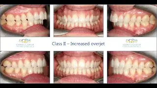Class II occlusion - TADs & Lingual braces