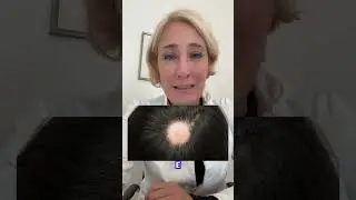 Capelli che cadono a chiazze: il segnale autoimmune che non devi ignorare