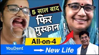 5 साल से बिना दाँत 😬 अब पाएं नई मुस्कान सिर्फ 3 दिन में | All-on-4 Dental Implants | YOU DENT Jaipur