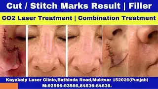 Cut / Stitch Marks Result | Filler, CO2 Laser Treatment | Combination Treatment