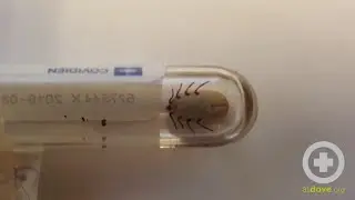 Tick Paralysis