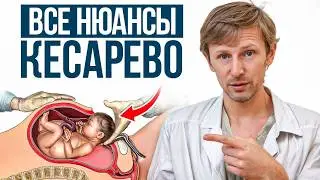 Врачи молчат об ЭТИХ последствиях КЕСАРЕВА! / Кесарево сечение или естественные роды?