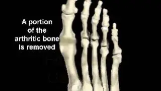 1st Metatarsal Phalangeal Joint Implant Surgical Animation