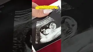 13. SSW 👶🤰🏼 Feindiagnostik / Ersttrimester Screening - das Ergebnis ❤️
