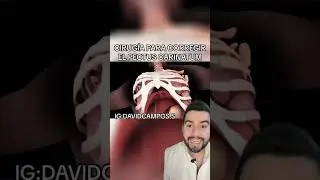 CORRECCION DEL PECTUS CARINATUM / PECHO DE PALOMA