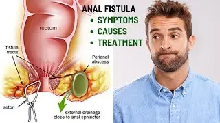 Pain, Discharge, and Swelling from Anal Fistulas? Get Expert Treatment with Dr. Shiraz Farooq