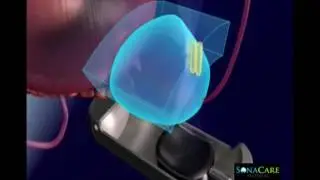 Sonablate HIFU Video: 720x1280 - wide screen