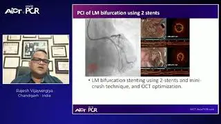 Optimised PCI in real-world complex lesions &ndash; AICT-AsiaPCR 2021