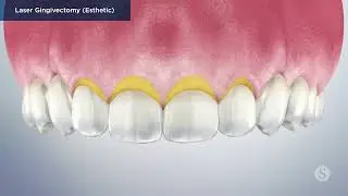 Laser Gingivectomy Esthetic