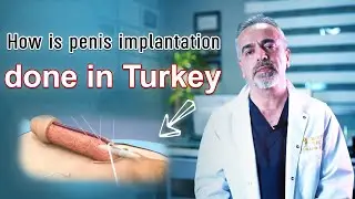 How is penis implantation done in Turkey?