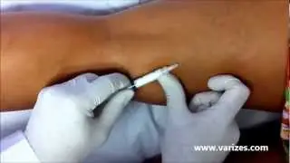 Escleroterapia com Espuma Densa ( Aplica&ccedil;&atilde;o de Varizes )