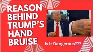 Trump's Hand Bruise??