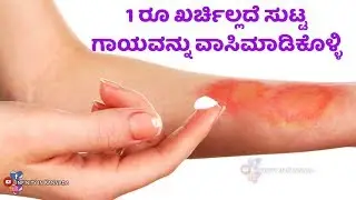 ಸುಟ್ಟ ಗಾಯಕ್ಕೆ ಮನೆ ಮದ್ದು | Burn Injury Treatment At Home In Kannada