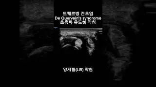 드퀘르벵 건초염(De Quervain's tenosynovitis) 초음파 유도하 약침치료(양계혈 약침)
