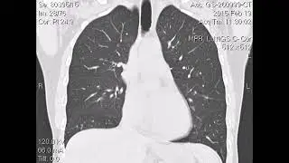 My Ct Scan part 1