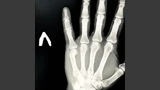 Stubby Fingers