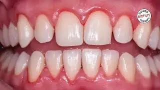 Teeth cleaning in dubai | Dr.Aimen Zia best dentist in dubai
