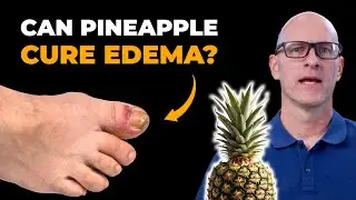 How Bromelain Can Boost Your Lymphatic Health and Reduce Swelling by 50%
