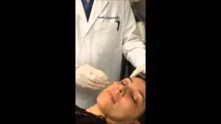 Micro Botox - Dr. David Goldberg Mini Series