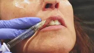 Dr Mark Beaty, Atlanta facial plastic surgeon, demonstrates lip augmentation with injectable filler.