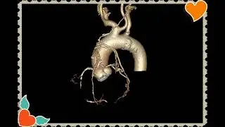 Coronary artery bypass graft (CABG) CT scan post processing Reconstructed images.