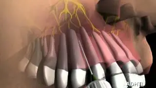 инфильтрационная анестезия верхних моляров...infiltration anesthesia of the upper molars