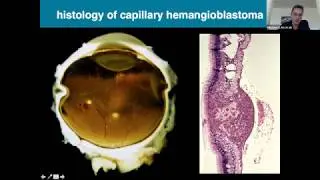 RareConnect.org Webinar: Diagnosis and treatment of retinal angiomas in VHL