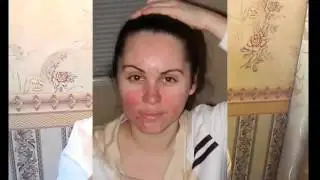 Как ВЫЛЕЧИТЬ ДЕМОДЕКОЗ КОЖНЫЙ КЛЕЩ спреями компании Alivemax элайфмакс эливемакс