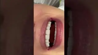 Ceramic veneers full rehabilitation #teethrestoration