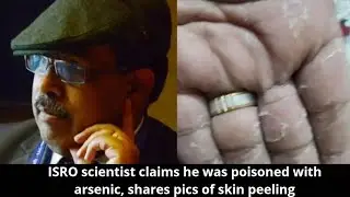 ISRO scientist claims he was poisoned with arsenic, shares pics of skin peeling | InSeconds