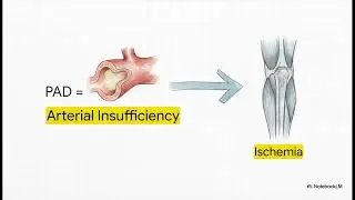Peripheral Arterial Disease (PAD)-Leg Pain With Walking = Arterial Disease