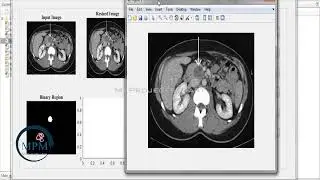 Pancreatic Tumor Classification in Medical Image System Using MATLAB - Digital Signal Processing
