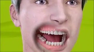 Trattamento dente singolo su impianto