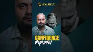 5700 Grafts Hair Transplant Surgery 😮 | Kolkata | Cost & Best Results #hairtransplant #shorts