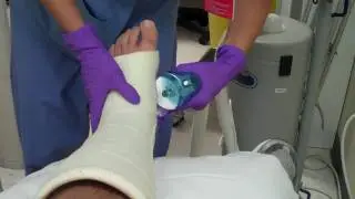 How to take off a Fiberglass Leg Cast