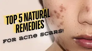 Top 5 Natural Remedies to Fade Acne Scars Fast | Effective and Easy Solutions