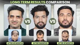 Best Hair Transplant in Surat (HX-GGFD) | Best Results & Cost of Hair Transplant in Surat.