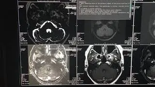 Importance of eliminating MRI artifact to improve diagnostic accuracy. Misdiagnosis of tumor