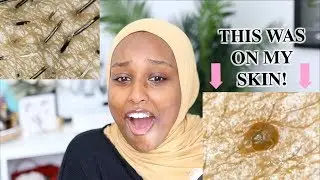 LOOKING AT MY SKIN UNDER A MICROSCOPE! | Aysha Harun