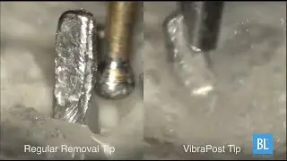 Use This To Remove Posts Faster For Dental Treatment.