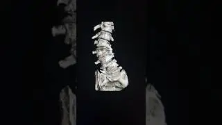 😱Ct LS spine (VRT) 3d view | Ct LS spine#radiology #radiologyeducation #ct #trending #bone #shorts