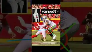 Врач объясняет травму колена Макса Кросби в матче против #Chiefs (2025) #Raiders #RaiderNation #Т...