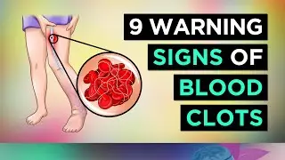 TOP 9 Warning SIGNS of BLOOD CLOTS