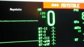 Asystole -with alarm sound